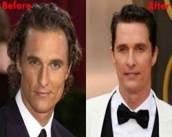 Matthew McConaughey before surgery